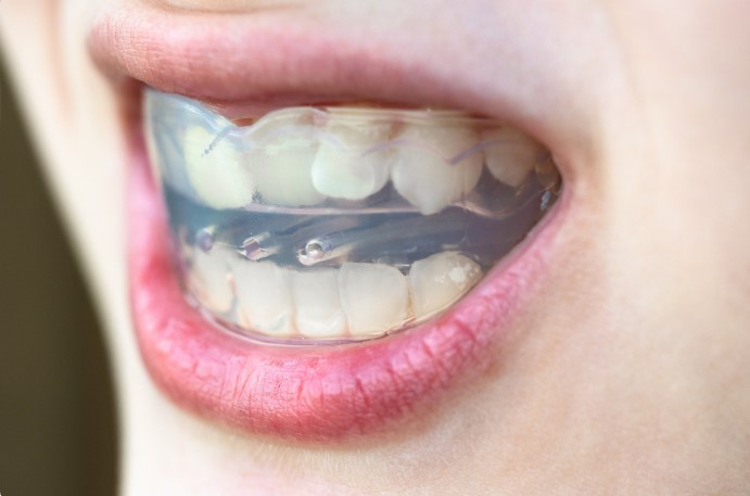 современные методы исправления прикуса